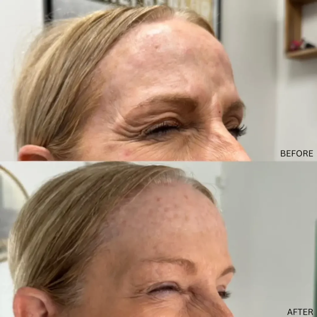 Inspo Medspa Before and After in Coral Springs FL