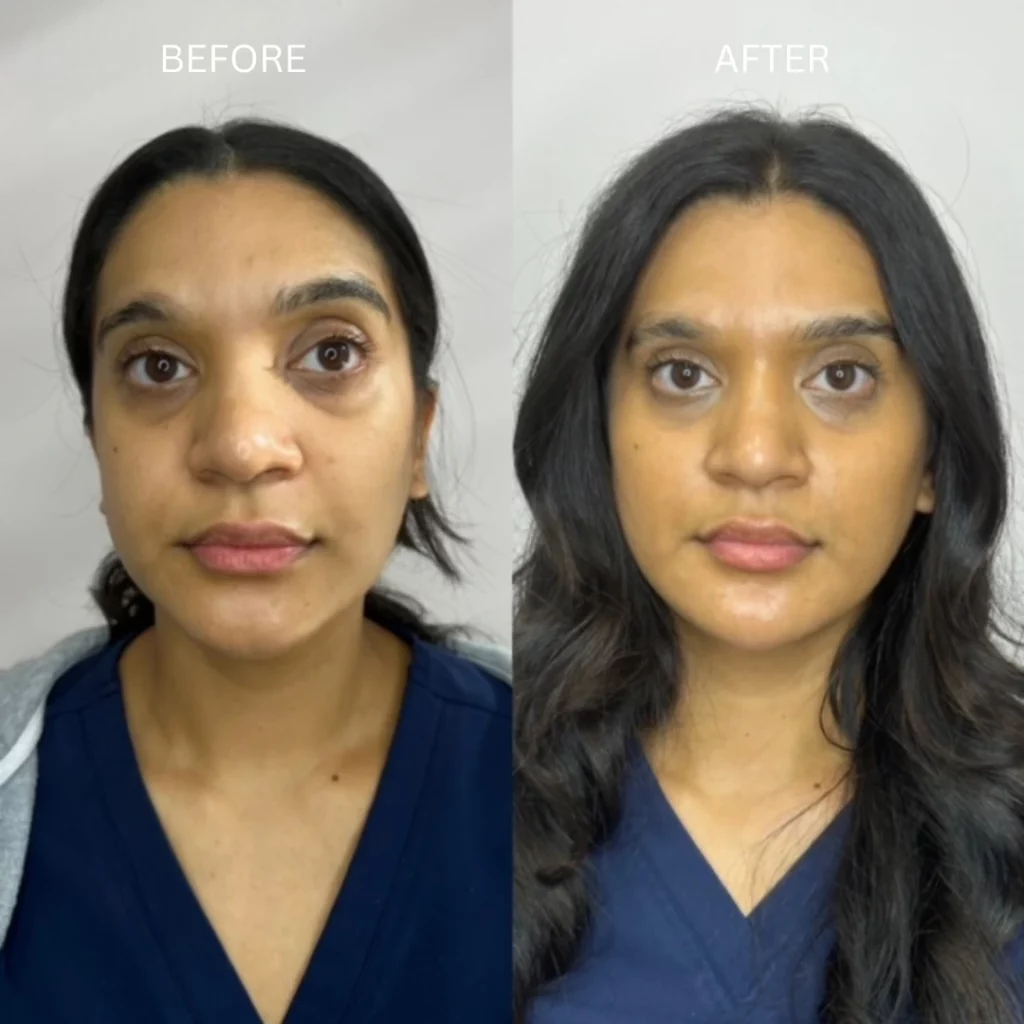 Dermal Fillers Before After A In Coral Springs FL | Inspo Medspa