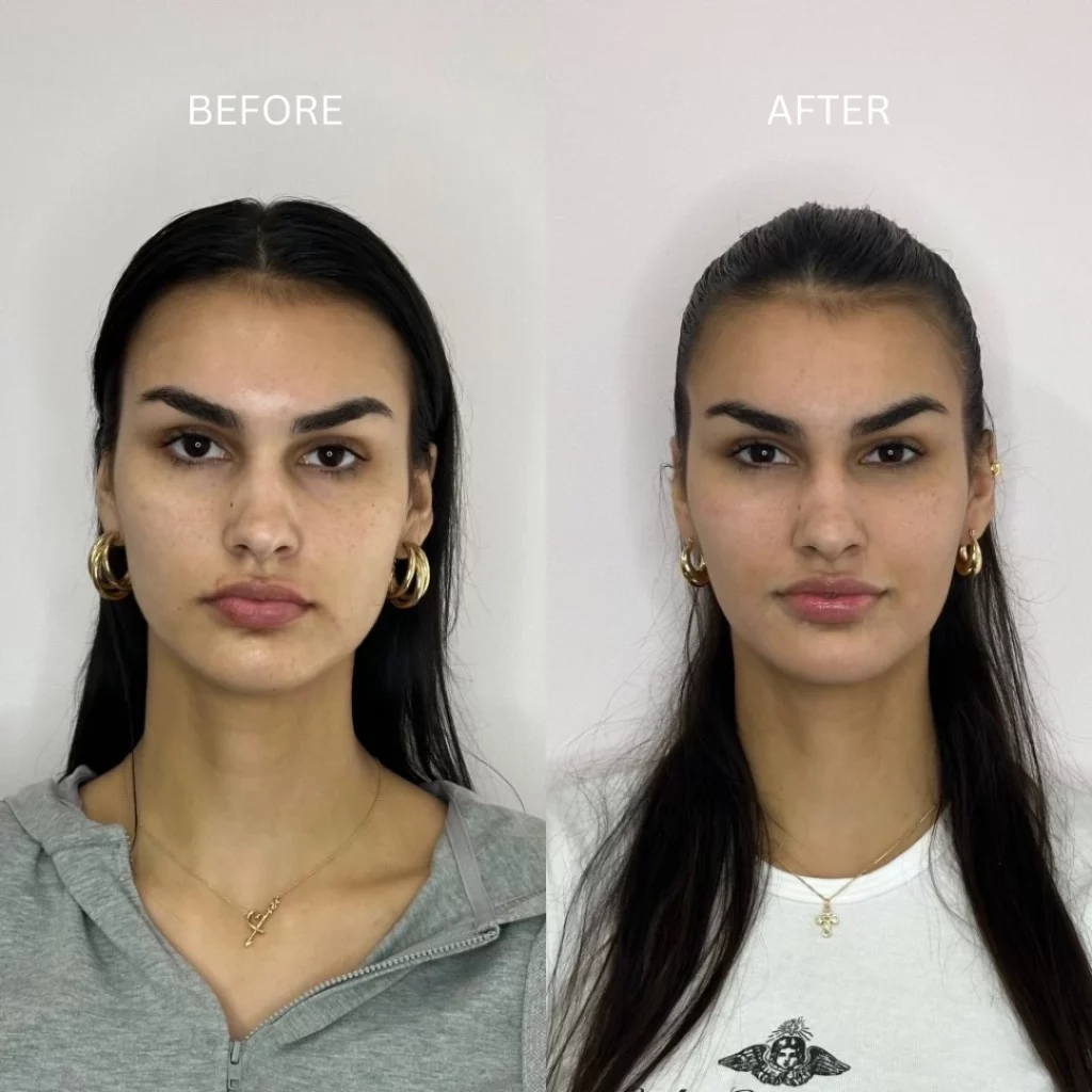 Dermal Fillers Before After B In Coral Springs FL | Inspo Medspa