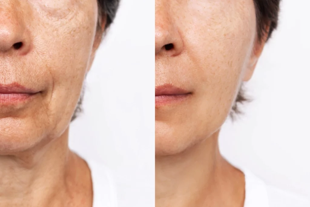 Harmonized Facial Contouring Broward County 