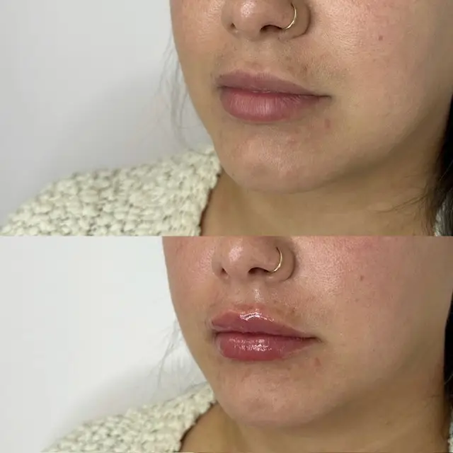 Inspo Medspa_Lip Filler gallery a in Coral Springs, FL