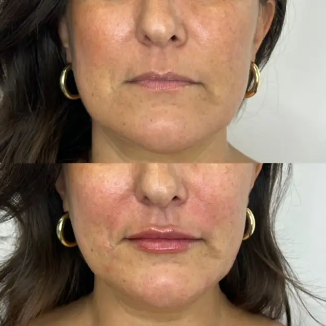 Inspo Medspa_Lip Filler gallery c in Coral Springs, FL