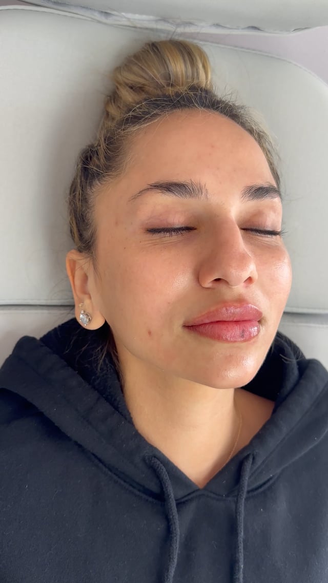 facial balancing in Deerfield Beach